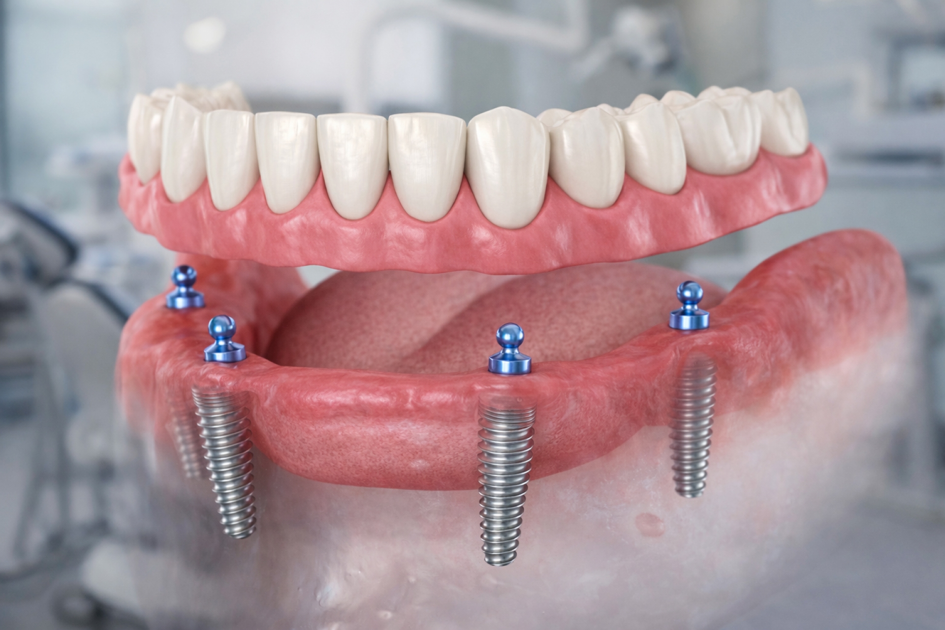 GANZKIEFER-IMPLANTATBEHANDLUNG